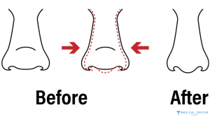 Rhinoplasty Surgery