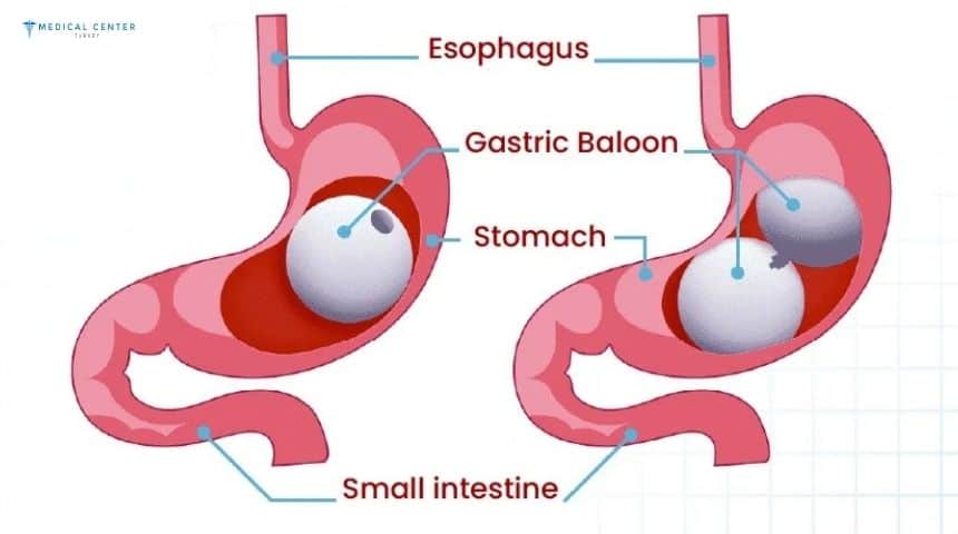Is the Gastric Balloon Right for You?