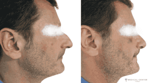 Is Turkey the Best Destination for Rhinoplasty in 2025?