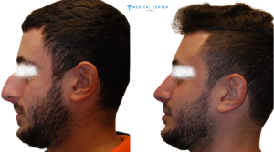 Is Turkey the Best Destination for Rhinoplasty?