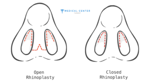 Is Turkey the Best Destination for Rhinoplasty?