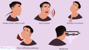 LASER SURGERY FOR LARYNGEAL CANCER 