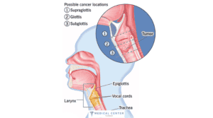 LASER SURGERY FOR LARYNGEAL CANCER