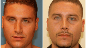 Latest Nose Surgery Techniques in Turkey