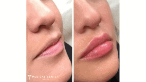 Lip Fillers Vs Lip Lift