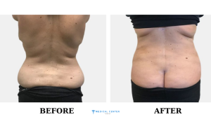 liposuction costs in Turkey 2024 1