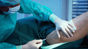 liposuction costs in Turkey 2024 3