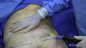 liposuction costs in Turkey 2024