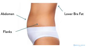 liposuction costs in Turkey 2024 