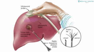 LIVER CANCER STAGE 3