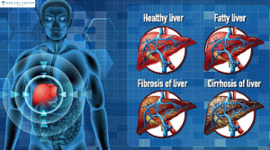 Liver Disease