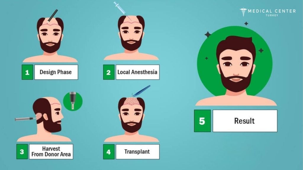Luca Hair Transplant Experince
