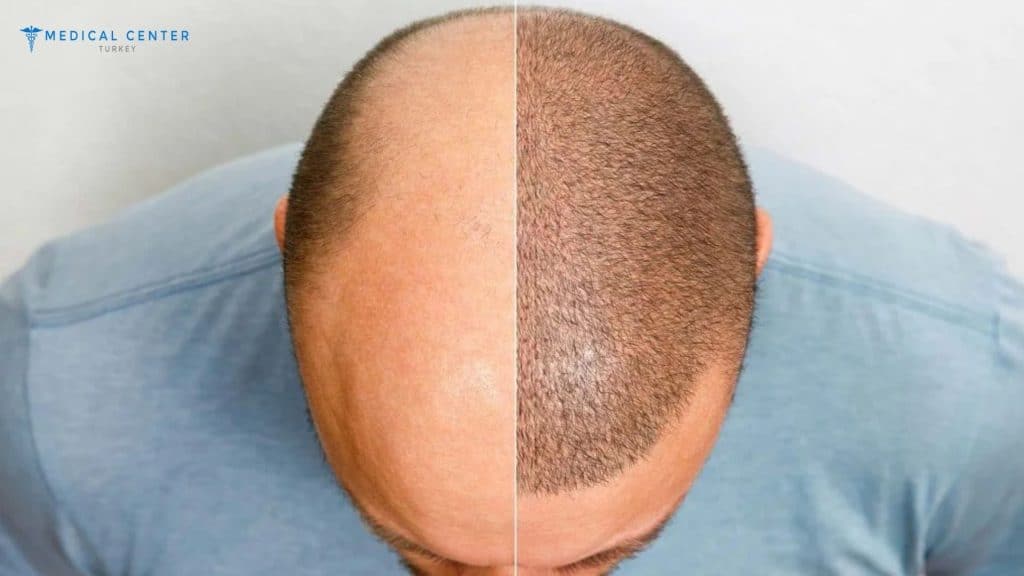 Luca Hair Transplant Experince