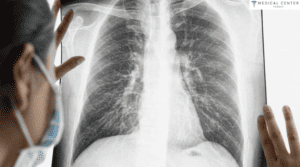 LUNG CANCER STAGE 4 