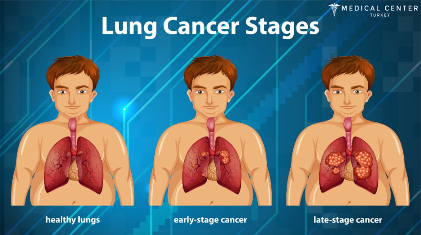Lung Cancer Surgery in Turkey
