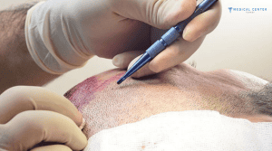 Manish’s Hair Transplant Experiences in Turkey