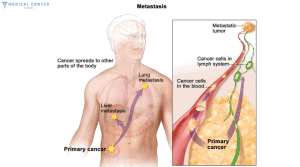 METASTATIC CANCER 