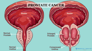 Metastatic Prostate Cancer: All You Need to Know