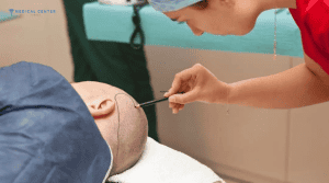 Micheal’s Hair Transplant Experiences in Turkey