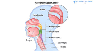 Nasopharyngeal Cancer 