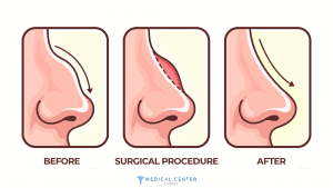 Natural Nose Job