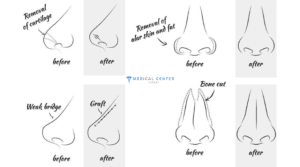 Nose Job Healing Time