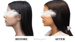 Nose Job Healing Time
