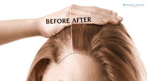 Olivia Hair Transplant Experiences in Turkey
