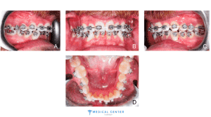 Orthodontic Treatments in Turkey