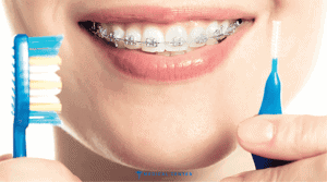 Orthodontic Treatments in Turkey