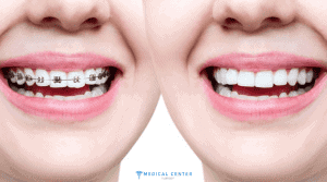 Orthodontic Treatments in Turkey