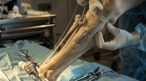 Orthopedic Surgery in Turkey: Recovering from Joint and Bone Procedures