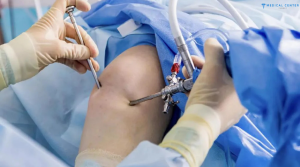 Orthopedic Surgery in Turkey: Recovering from Joint and Bone Procedures