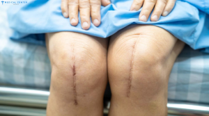 Orthopedic Surgery in Turkey: Recovering from Joint and Bone Procedures
