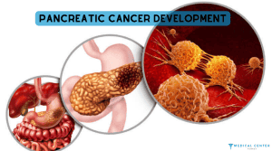 Pancreatic Cancer Treatment in Turkey