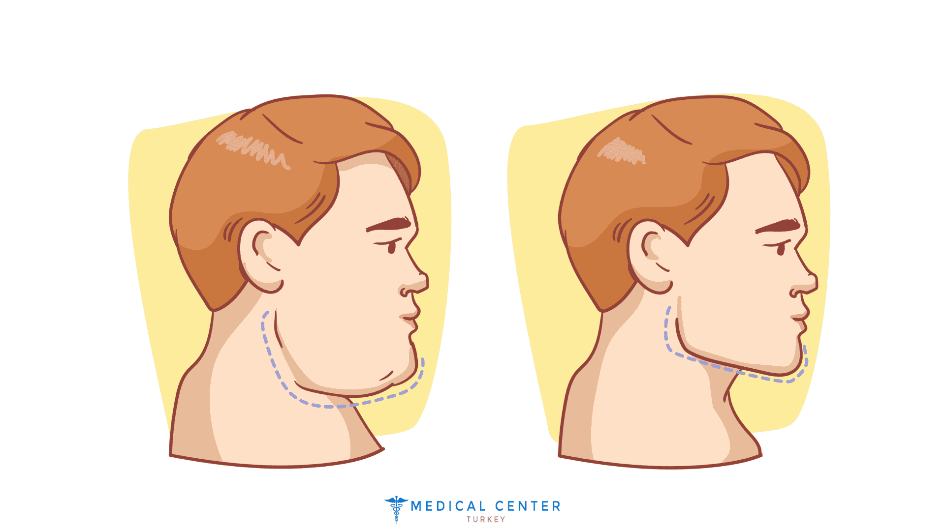 Plastic Surgery for Men Trends And Procedures