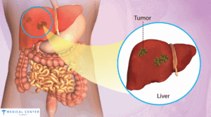 REMOVAL OF LIVER CANCER