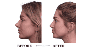 Revision Rhinoplasty in Turkey 2025
