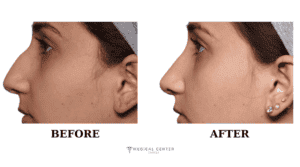 Rhinoplasty Cost in Turkey