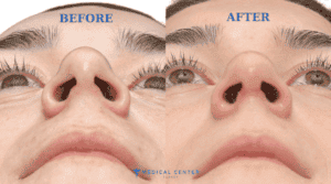 Rhinoplasty Techniques Open vs Closed Surgery 1