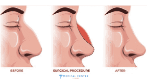 Rhinoplasty Techniques Open vs Closed Surger