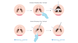 Rhinoplasty Techniques Open vs Closed Surgery 