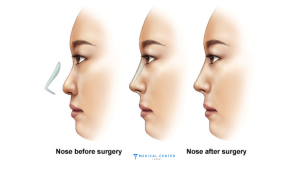 Rhinoplasty vs. Non-Surgical Nose Jobs