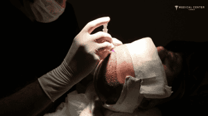 Roman’s Hair Transplant Experiences in Turkey