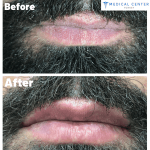 The Secret of Kylie Jenner's Lips