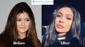 The Secret of Kylie Jenner's Lips
