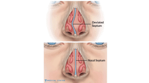 Septoplasty Cost in Turkey