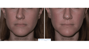 Septoplasty Cost in Turkey