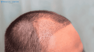 Shock Loss After Hair Transplant