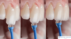 Smile Makeover Cost 